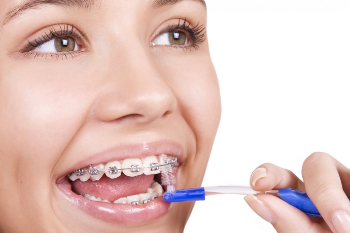 ​Акции на брекеты в стоматологии - отличный шанс получить красивую и здоровую улыбку